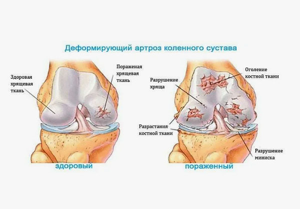 Деформирующий артроз